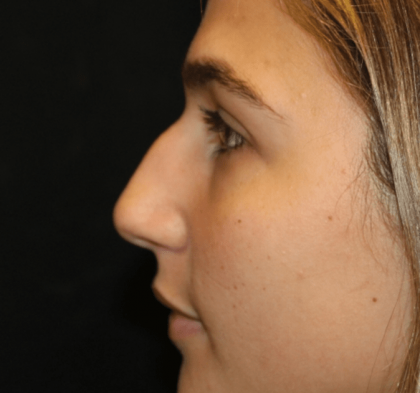 Rhinoplasty Before & After Patient #30883