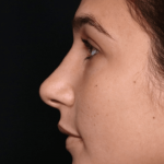 Rhinoplasty Before & After Patient #30883