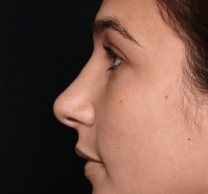 Rhinoplasty Before & After Patient #30883