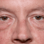 Blepharoplasty Before & After Patient #30961