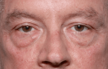 Blepharoplasty Before & After Patient #30961