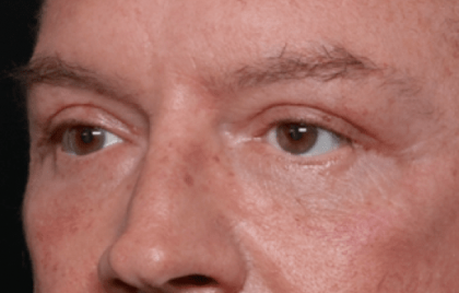 Blepharoplasty Before & After Patient #30961