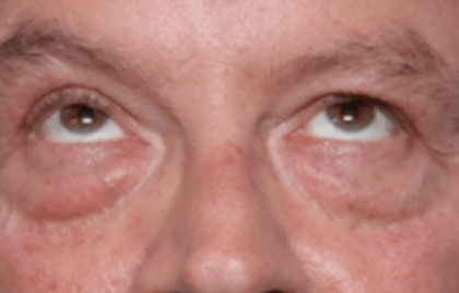 Blepharoplasty Before & After Patient #30961