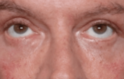 Blepharoplasty Before & After Patient #30961