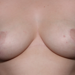 Breast Reduction Before & After Patient #31012