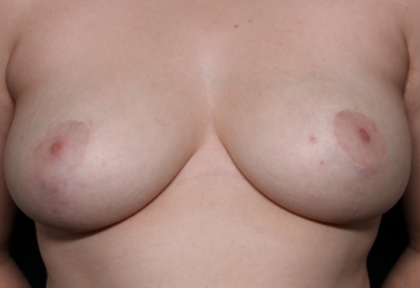 Breast Reduction Before & After Patient #31012