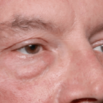 Blepharoplasty Before & After Patient #30961