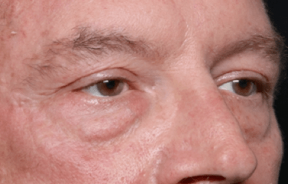 Blepharoplasty Before & After Patient #30961