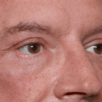 Blepharoplasty Before & After Patient #30961