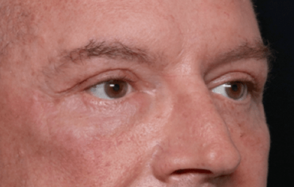 Blepharoplasty Before & After Patient #30961