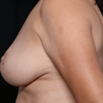 Breast Reduction Before & After Patient #30950