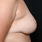 Breast Reduction Before & After Patient #30983