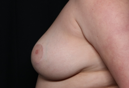 Breast Reduction Before & After Patient #31012