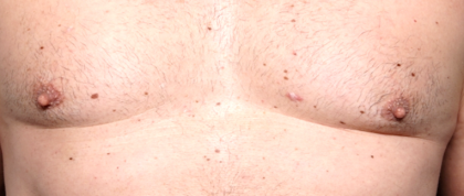 Gynecomastia Before & After Patient #30976