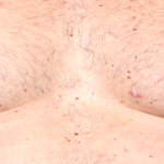 Gynecomastia Before & After Patient #30976