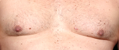 Gynecomastia Before & After Patient #30976