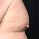 Gynecomastia Before & After Patient #30976