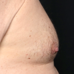 Gynecomastia Before & After Patient #30976