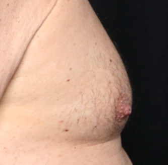 Gynecomastia Before & After Patient #30976