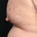 Gynecomastia Before & After Patient #30976