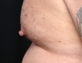 Gynecomastia Before & After Patient #30976