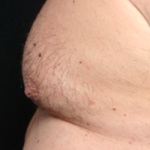 Gynecomastia Before & After Patient #30976