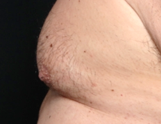 Gynecomastia Before & After Patient #30976