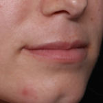 Lip Filler Before & After Patient #30934