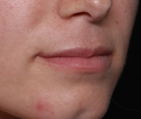 Lip Filler Before & After Patient #30934