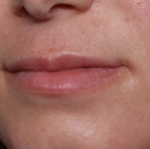 Lip Filler Before & After Patient #30934