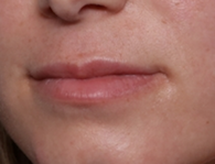 Lip Filler Before & After Patient #30934