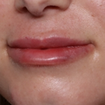 Lip Filler Before & After Patient #30934