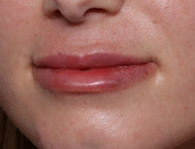 Lip Filler Before & After Patient #30934