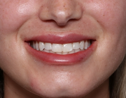 Lip Filler Before & After Patient #30934