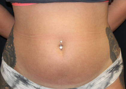 Liposuction Before & After Patient #30898