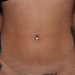 Liposuction Before & After Patient #30898