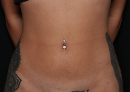 Liposuction Before & After Patient #30898