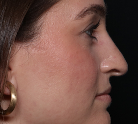 Rhinoplasty Before & After Patient #30921