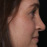 Rhinoplasty Before & After Patient #30921