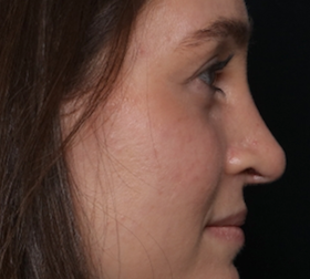 Rhinoplasty Before & After Patient #30921