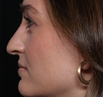 Rhinoplasty Before & After Patient #30921