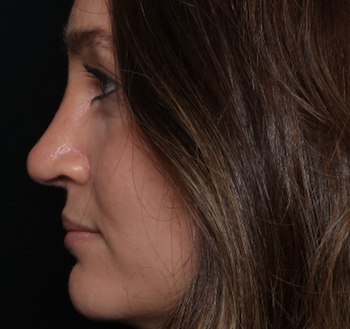 Rhinoplasty Before & After Patient #30921