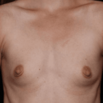 Breast Augmentation Before & After Patient #31038