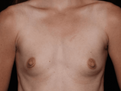 Breast Augmentation Before & After Patient #31038