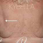 Kybella Before & After Patient #31140