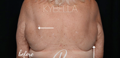 Kybella Before & After Patient #31140