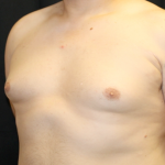 Gynecomastia Before & After Patient #31146