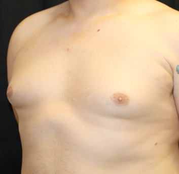 Gynecomastia Before & After Patient #31146