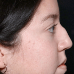 Rhinoplasty Before & After Patient #31050