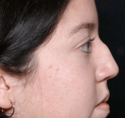 Rhinoplasty Before & After Patient #31050